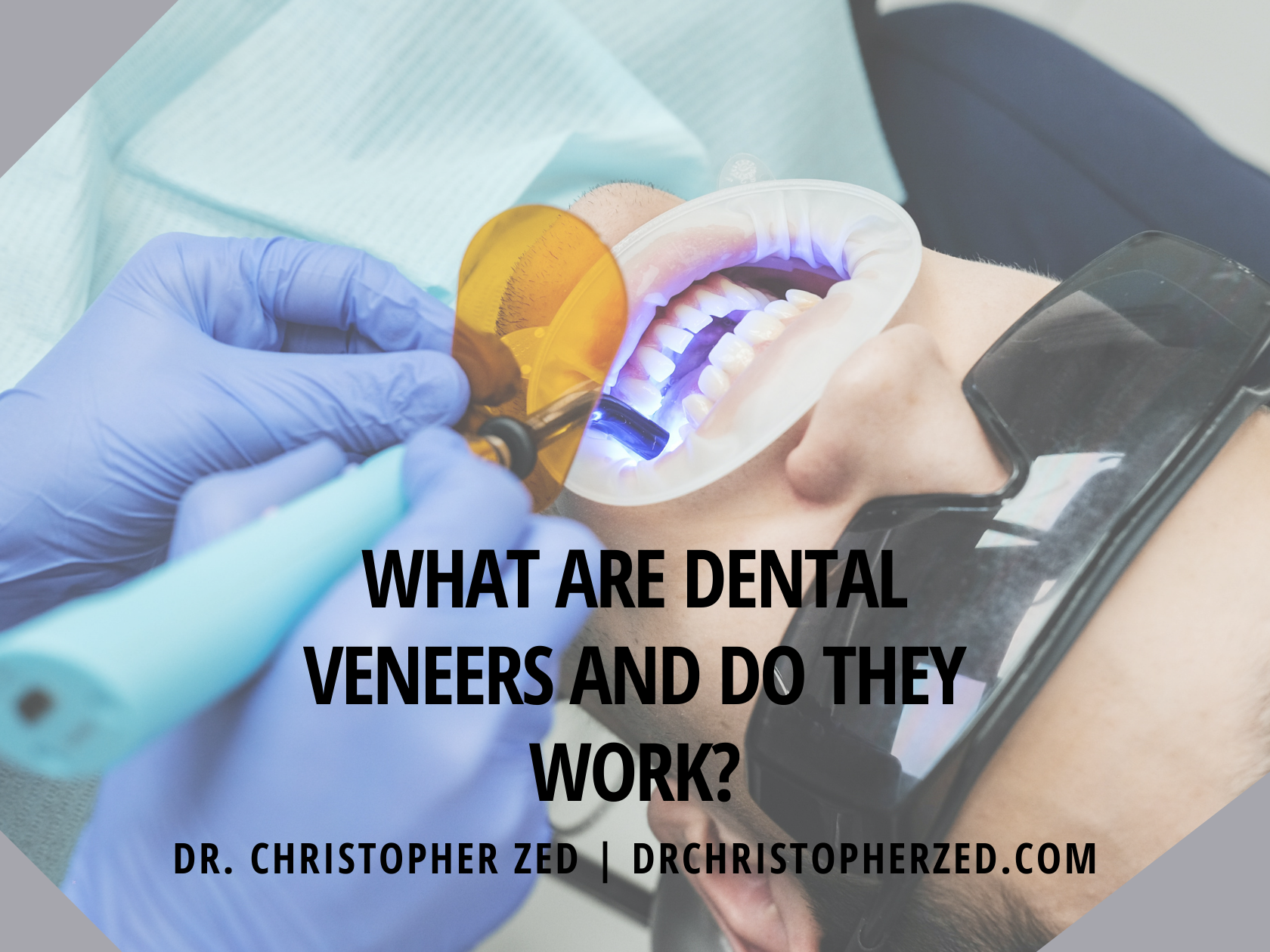 Cover of What are Dental Veneers and Do They Work?.